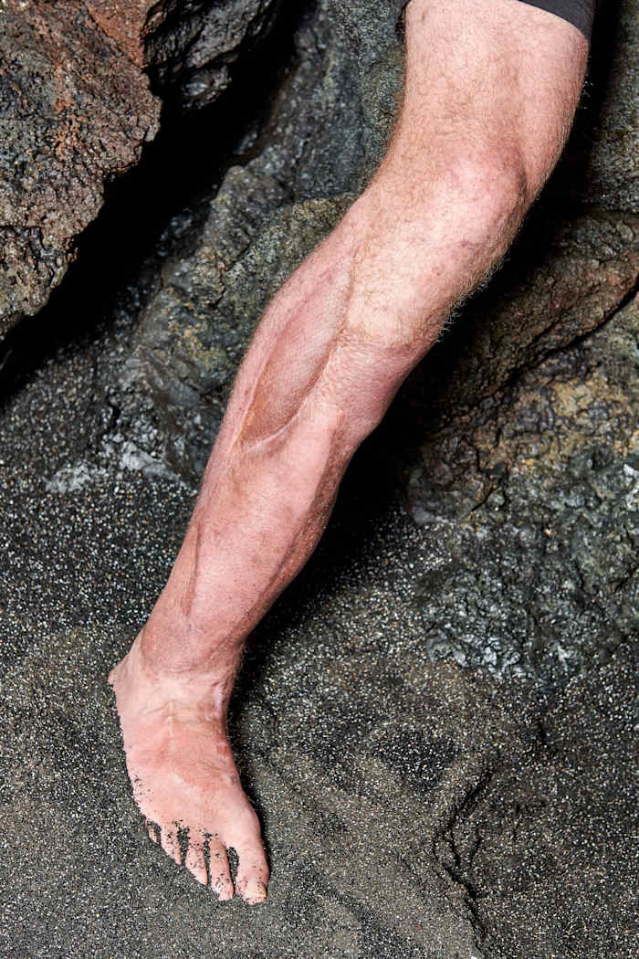 Alex Smith's injured right leg